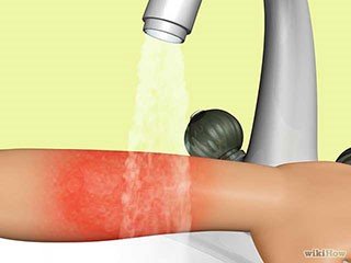 被火烧伤后急救,烧伤急救五部曲