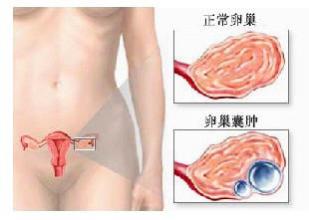 怎么预防卵巢囊肿的复发,怎么预防卵巢囊肿子宫肌瘤