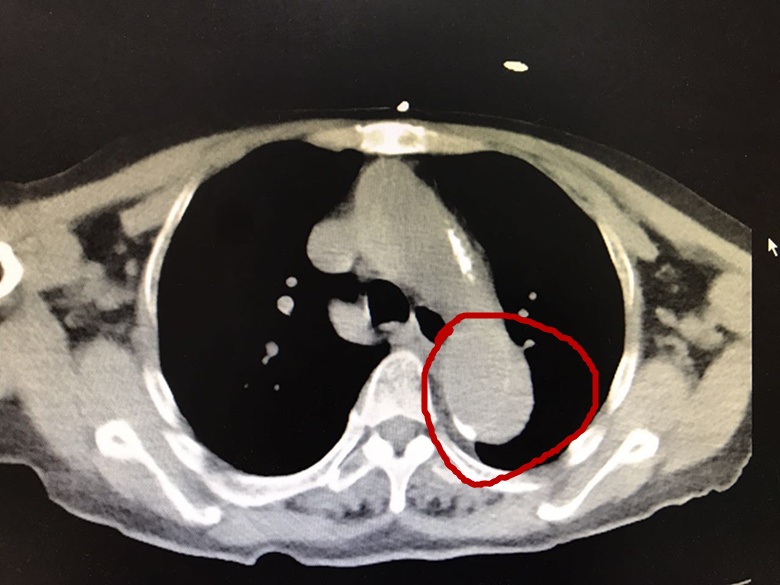 80岁主动脉夹层自愈真实案例,关于主动脉夹层的小故事