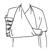 腿部骨折急救方案,骨折的现场急救