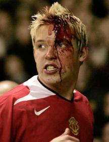 心疼！内少血染赛场足坛那些血染赛场的硬汉们