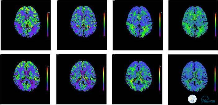 大脑中动脉侧支代偿正常标准,什么是左侧大脑中动脉代偿供血