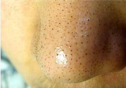 黑头反复挤不完的原因,黑头产生的原因及解决方法