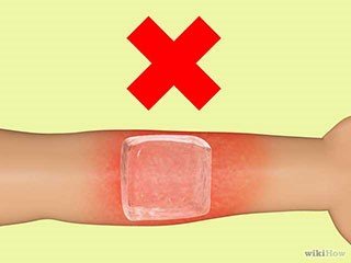 被火烧伤后急救,烧伤急救五部曲