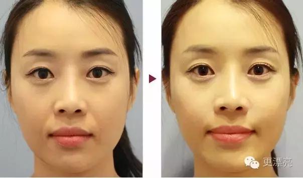 爱笑的女孩法令纹都很深,爱笑的女孩法令纹都不会太差