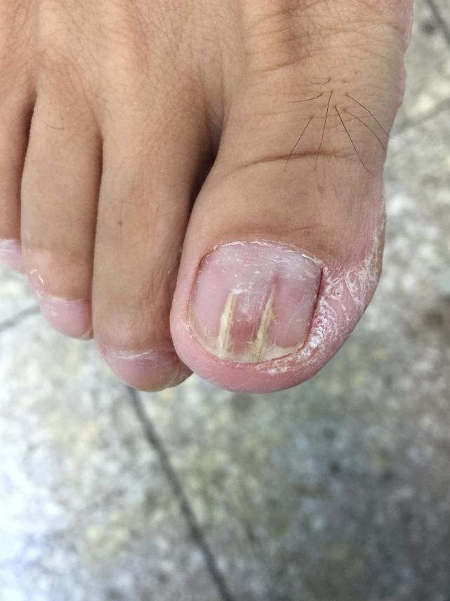 灰指甲为什么反反复复那么难治,为什么这么多人有灰指甲