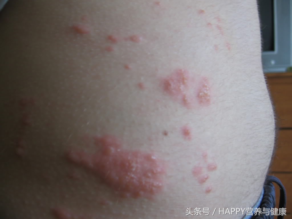 皮肤科怎么治疗长疮,皮肤疮的症状有哪些