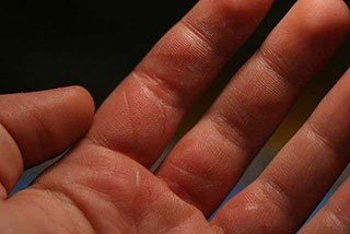 被火烧伤后急救,烧伤急救五部曲