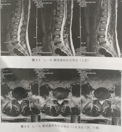 腰椎间盘突出可以练瑜伽吗,腰椎间盘突出可以做什么运动