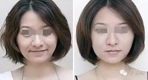 爱笑的女孩法令纹都很深,爱笑的女孩法令纹都不会太差