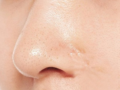 越南去除鼻子黑头,怎么去除鼻子黑头粉刺