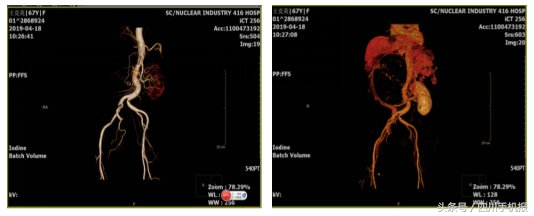 婆婆腹中长足球大的瘤！还两个！看医生们“拆弹”