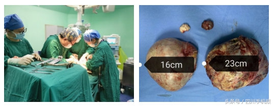 婆婆腹中长足球大的瘤！还两个！看医生们“拆弹”