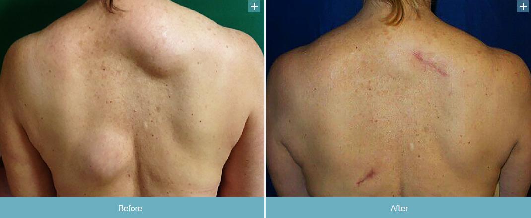 脂肪瘤长得比较快是因为恶变了吗,长了一个脂肪瘤必须赶紧做手术吗