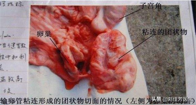 疏通输卵管堵塞的最佳时间和方法,出现输卵管堵塞怎么疏通最快