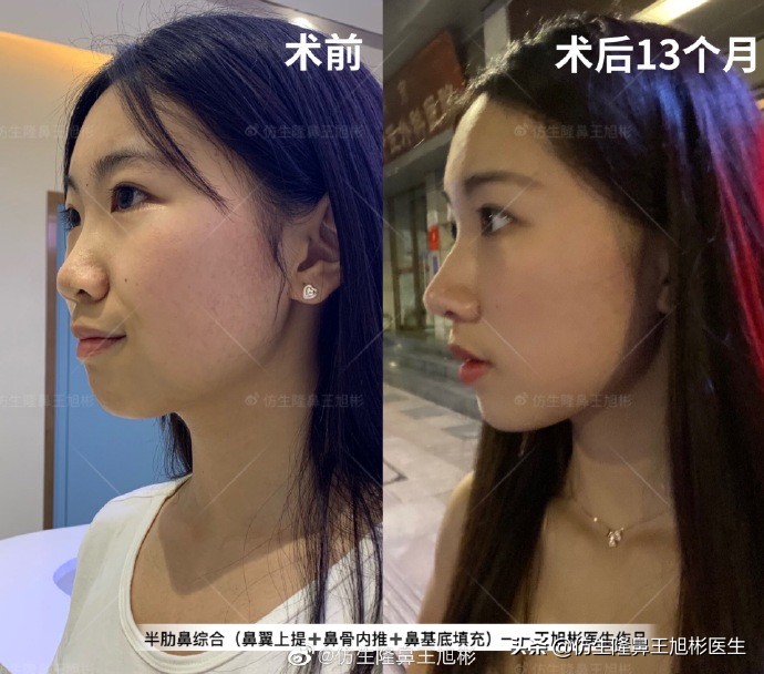 那些被鼻子“封印”颜值的鼻综合/修复案例|广州鼻整形