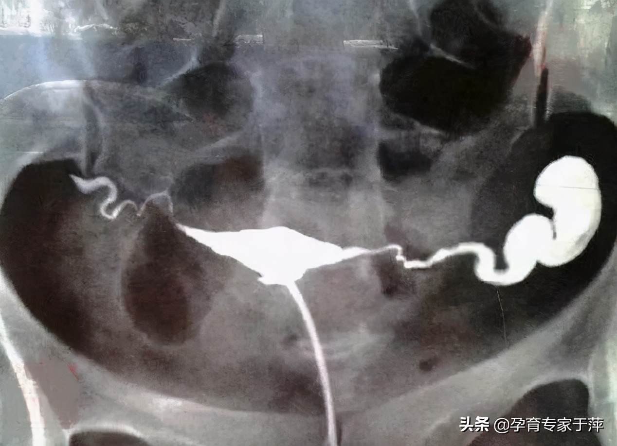 于萍讲输卵管不孕,输卵管因素导致不孕最常见的原因