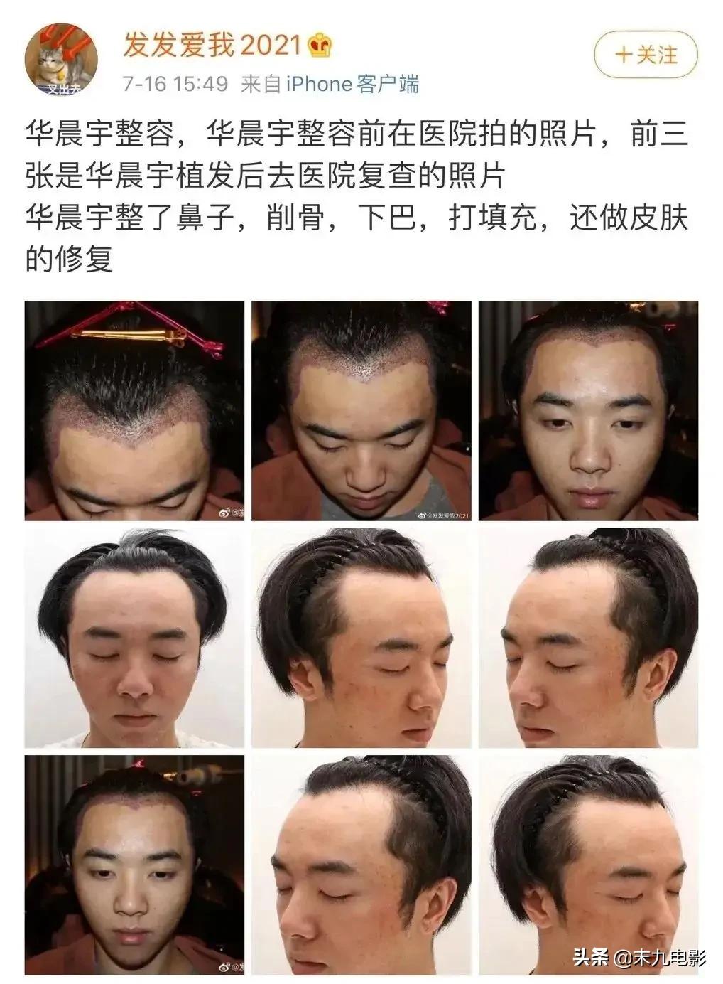 华晨宇植发照片是真的吗,华晨宇植发之前的照片长什么样子