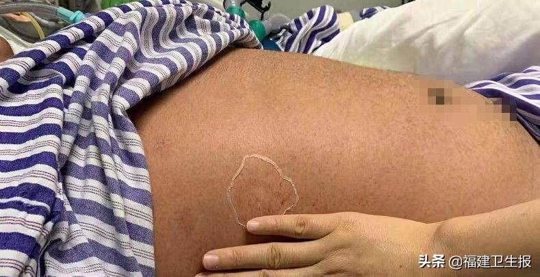 福建16岁少年发热出疹，一度昏迷！竟是患上这种传染病！早期症状像感冒，家长注意