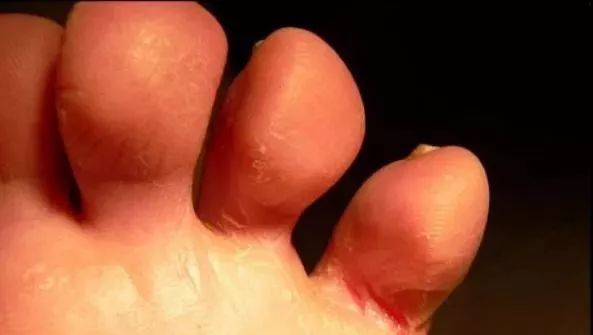 脚部一旦出现这3种情况,什么病会在脚部出现症状