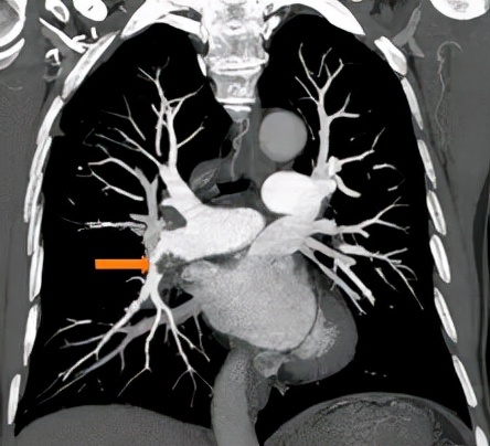 一个肠息肉切除干净后还会复发吗,肠息肉esd手术可以切除多大息肉