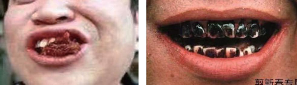 口腔吃槟榔吃坏了怎么修复,吃槟榔口腔内壁长了个疙瘩