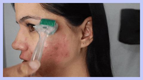 痘印痘坑目前治疗方法哪个最好,医美机构靠药物去痘印痘坑可靠吗