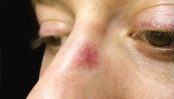 出现痣警惕肝脏病变,肝痣是肝脏发出的求救信号