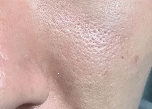 皮肤粗糙毛孔粗大最快的解决办法,皮肤松弛毛孔粗大黑头多怎么解决