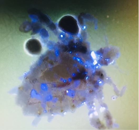 小孩眼睛痒是有虫子吗,儿童眼痒掏出六条虫