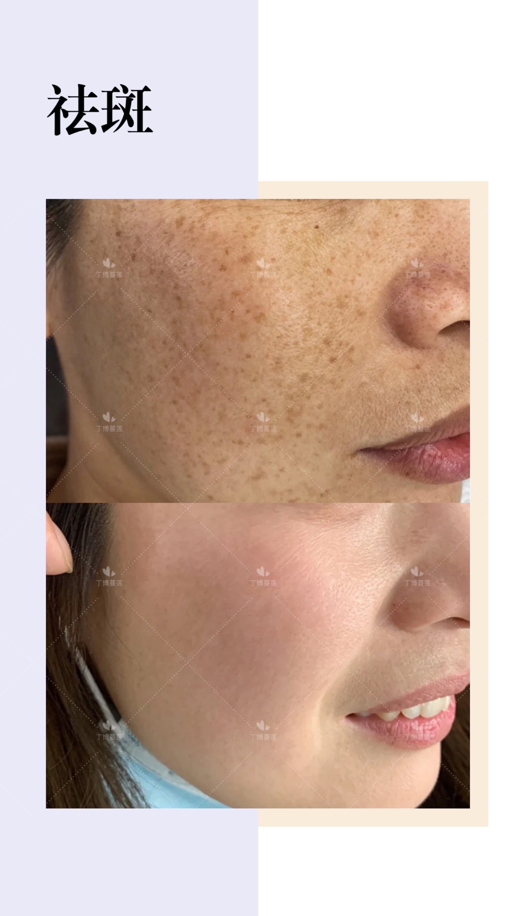 脸上雀斑祛斑最好最安全的方案,根治雀斑祛斑最有效方法