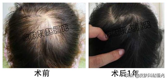 女生头顶头发越来越少了怎么办,脱发严重头顶头发越来越少了