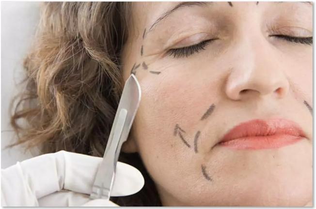 做一个拉皮手术人可以年轻多少岁,做拉皮的真实感受