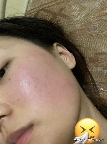 脸部毛孔大泛红有红血丝,脸部毛孔粗大有红血丝怎么改善