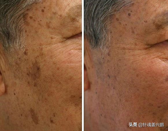 女性40岁脸上出现老年斑怎么回事,40-50脸上有老年斑什么原因