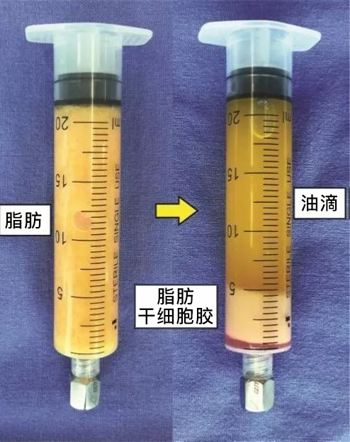 脂肪胶填充好还是svf填充好,脂肪填充用干细胞还是prp好