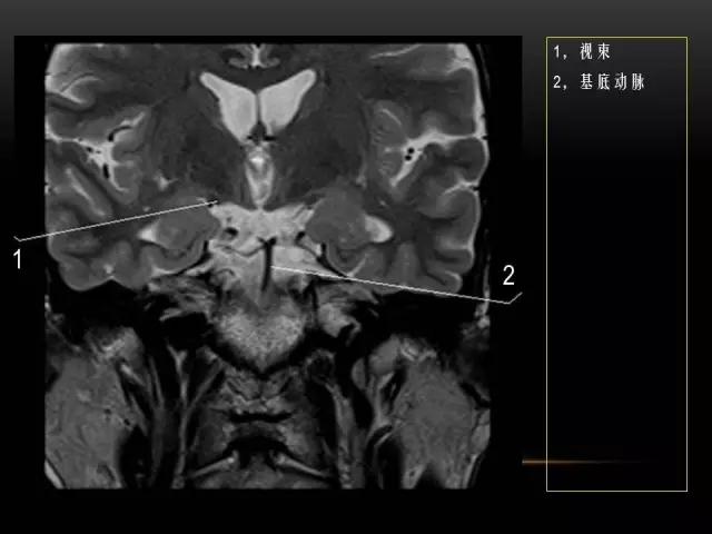 鼻腔鼻窦及颅底ct影像解剖,鼻窦解剖mri