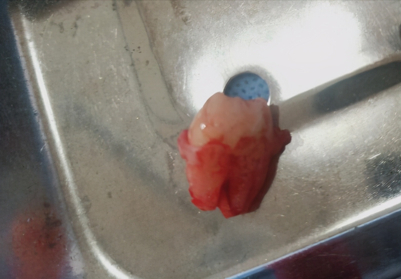 拔完智齿第三天就开始撸串了,智齿拔完一周可以撸铁吗