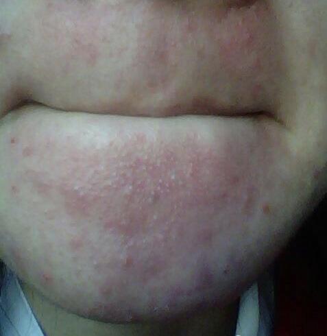 身上的痘痘跟痘印该怎么去除,祛除痘痘和痘印最快方法