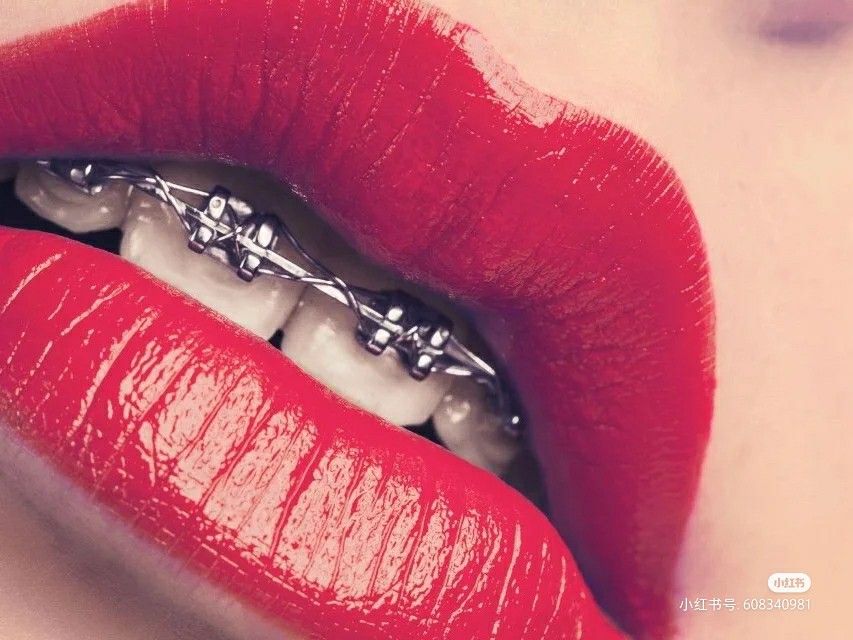 杭州做矫正牙齿价格多少,在杭州做牙齿修复多少钱