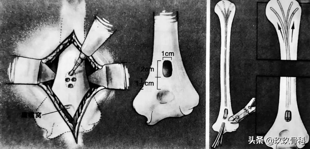 骨科用髓内钉什么材料,骨科髓内钉的作用