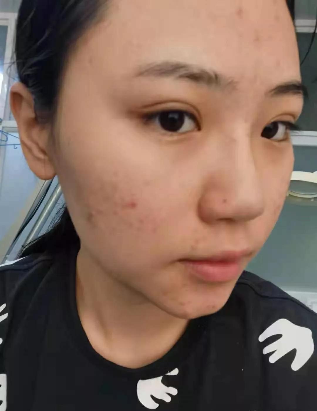 北京看痘痘好的皮肤科医院,去皮肤科看痘痘好不好