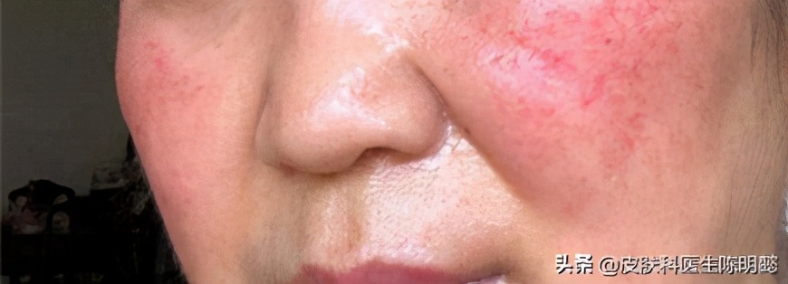 玫瑰痤疮别名酒糟鼻怎么治疗,玫瑰痤疮酒糟鼻怎么治啊