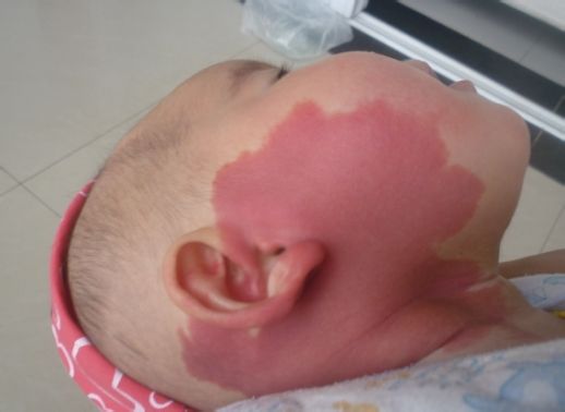 血管瘤鲜红斑痣是什么原因导致的,鲜红斑痣是不是比血管瘤厉害难治