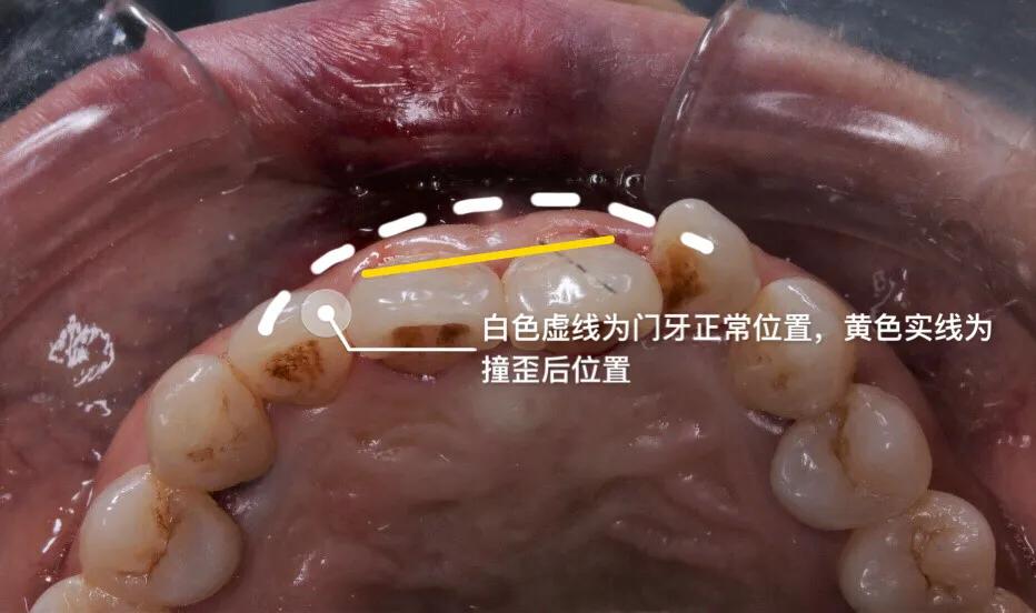 小明的牙齿被撞歪？1：1还原治疗过程，不让意外伤害一颗好牙