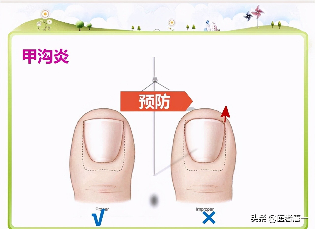 甲沟炎是不是治不好呀,甲沟炎对脚趾的伤害