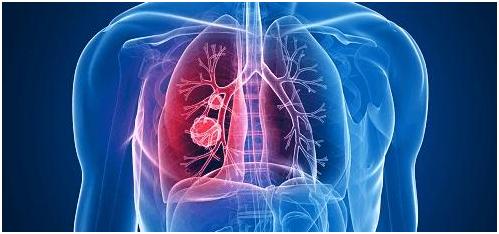肺癌定义、病因、病理及病理策划学分类