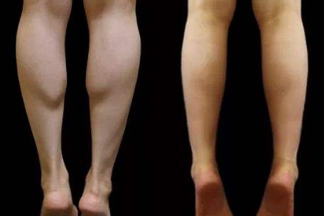 大象腿最快的解决方法,告别大象腿瘦腿秘诀一网打尽