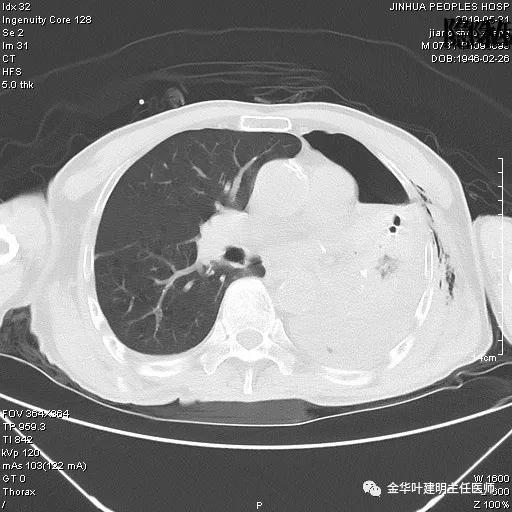 手术引起乳糜胸,有没有做了肺结节手术后是误诊的