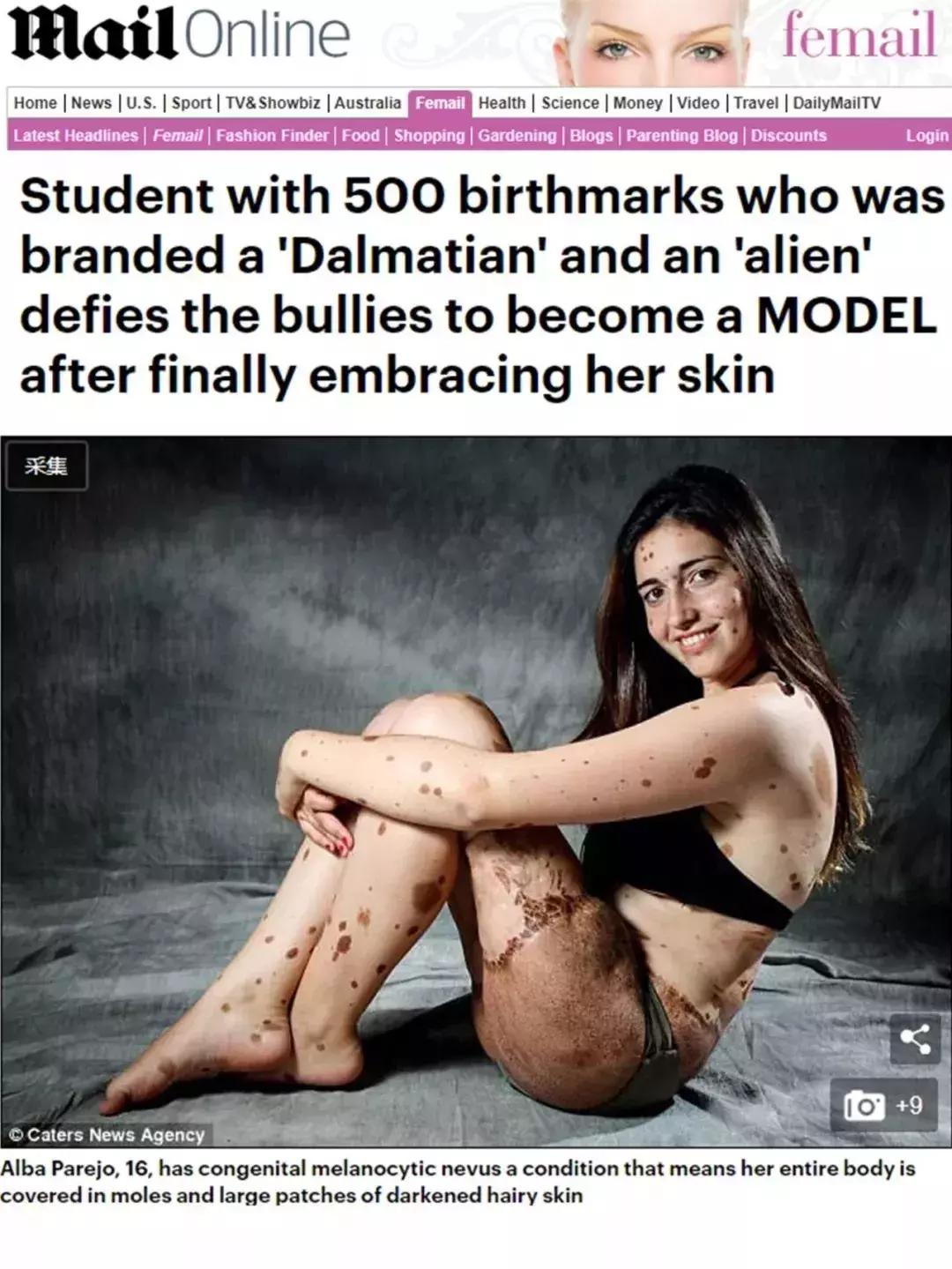 全身黑斑被骂“斑点狗”，身高160的她却成为最美超模…